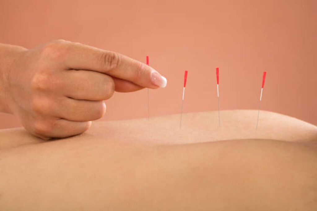 Ivf Acupuncture