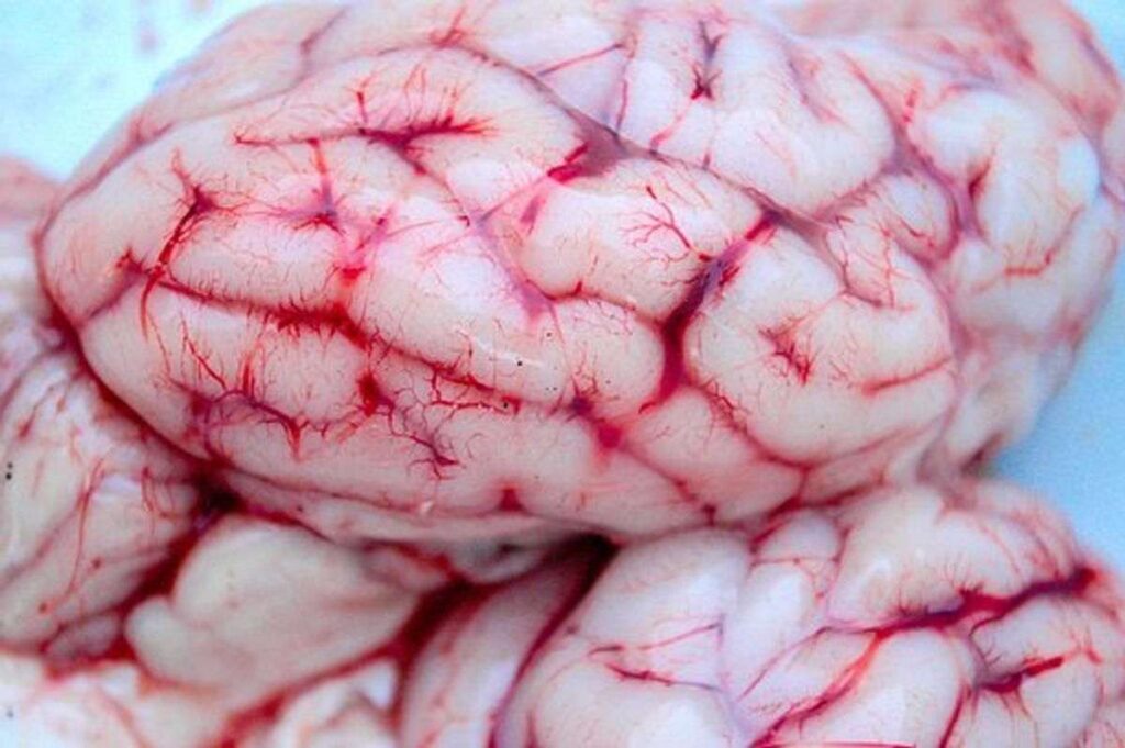 Bleeding in the Brain