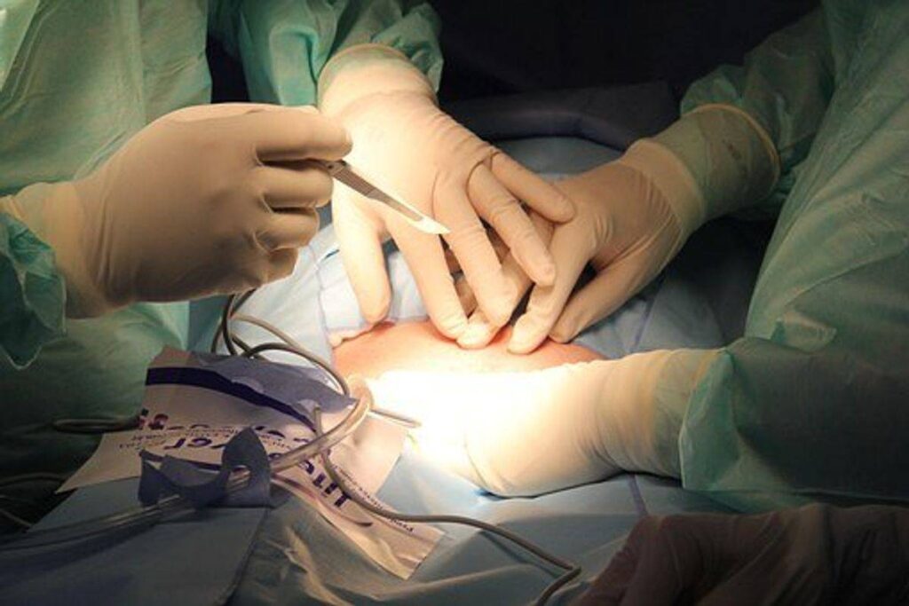 Why I Want Gastric Bypass Surgery