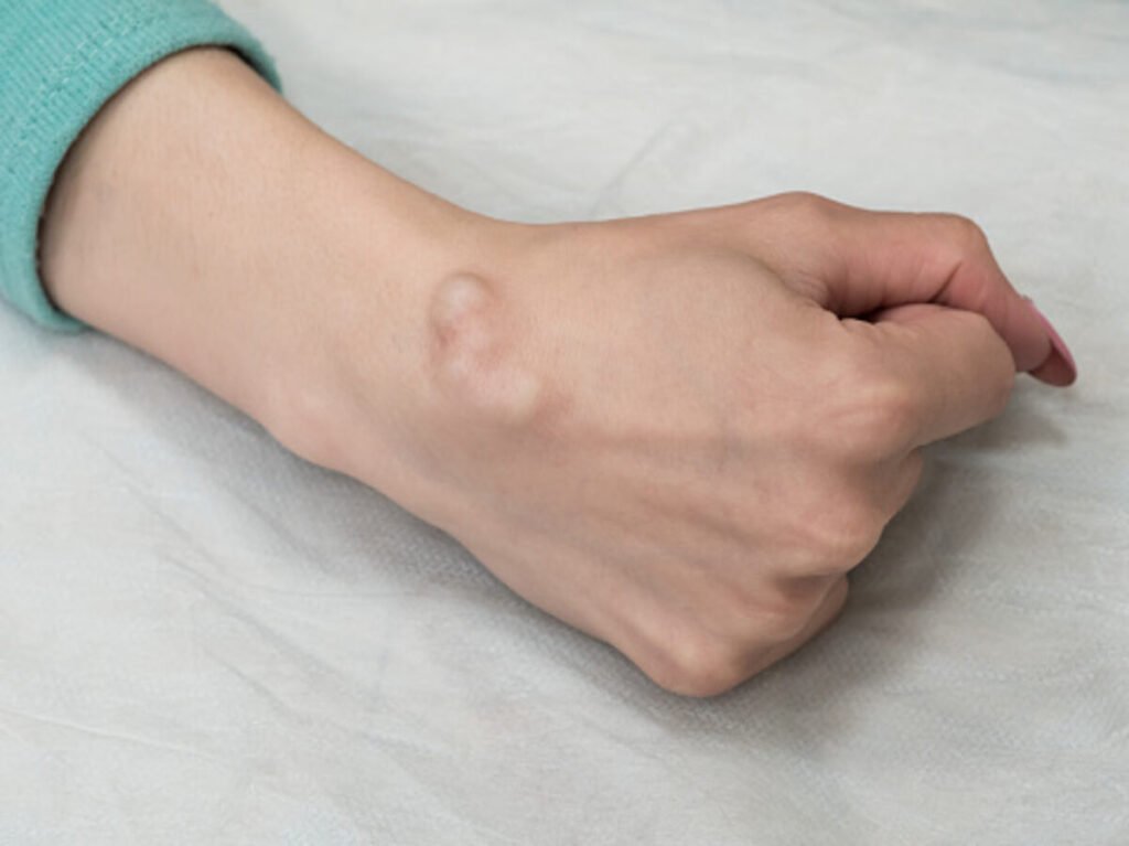what is a cyst