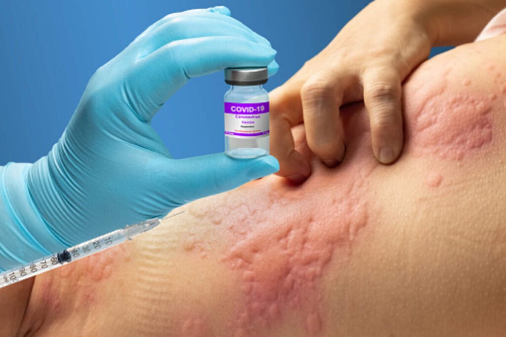 allergy symptoms