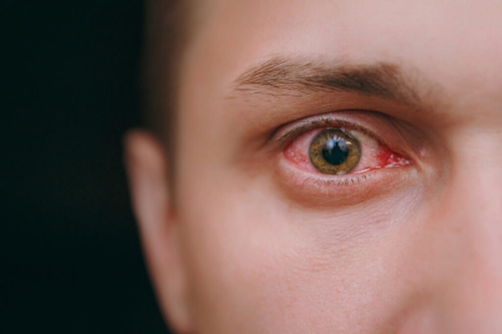 what is pink eye