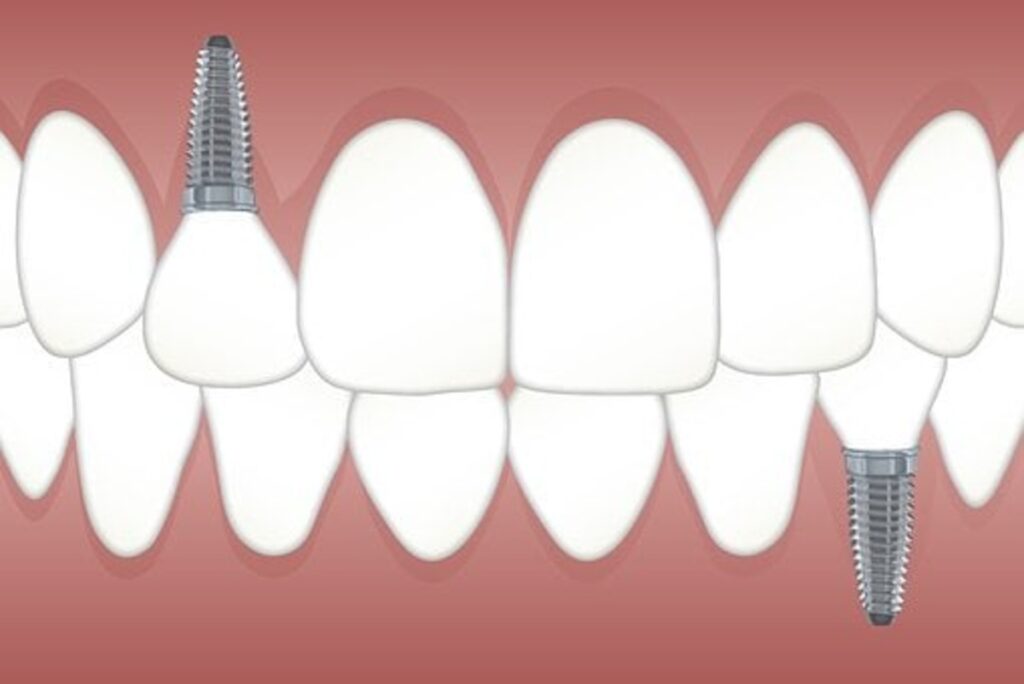 dream veneers reviews
